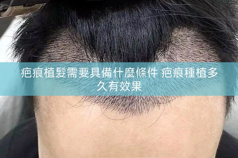 疤痕植髮需要具備什麼條件 疤痕種植多久有效果
