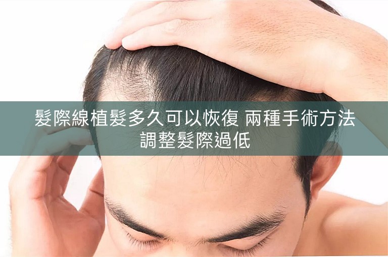 髮際線植髮多久可以恢復 兩種手術方法調整髮際過低