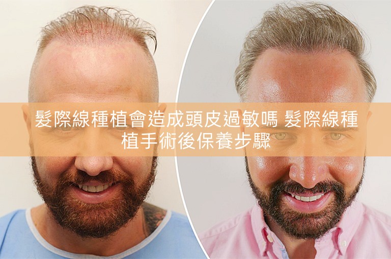 髮際線種植會造成頭皮過敏嗎 髮際線種植手術後保養步驟