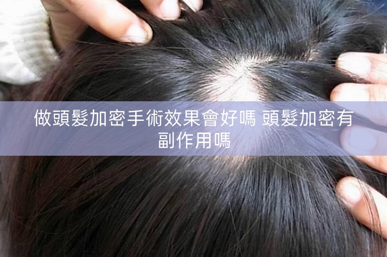 做頭髮加密手術效果會好嗎 頭髮加密有副作用嗎