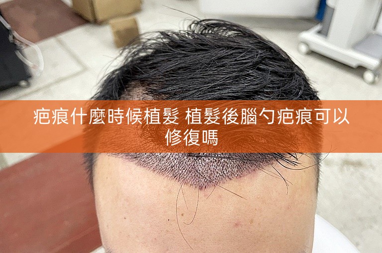 疤痕什麼時候植髮 植髮後腦勺疤痕可以修復嗎