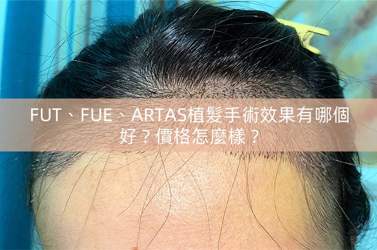 FUT、FUE、ARTAS植髮手術效果有哪個好？價格怎麼樣？