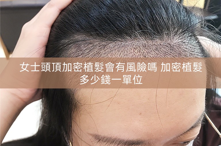 女士頭頂加密植髮會有風險嗎 加密植髮多少錢一單位