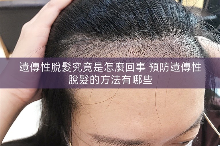 遺傳性脫髮究竟是怎麼回事 預防遺傳性脫髮的方法有哪些